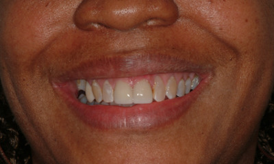Before-and-After-Ceramic-Crowns-After-Image