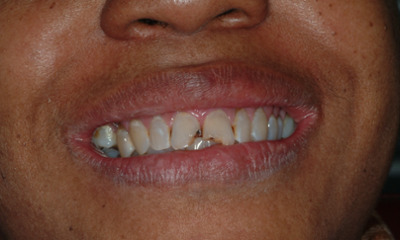 Before-and-After-Ceramic-Crowns-Before-Image